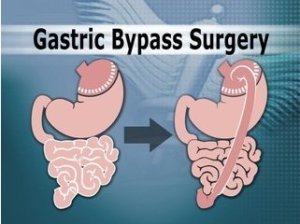gastric-bypass-rose-749525